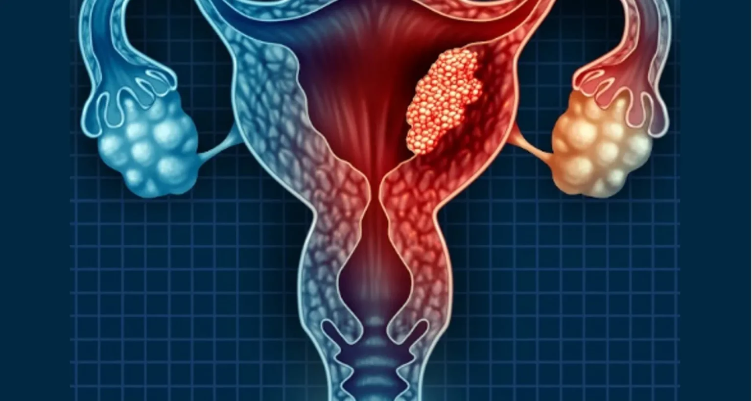 What is the average cost of cervical cancer treatment in India? How to manage it?